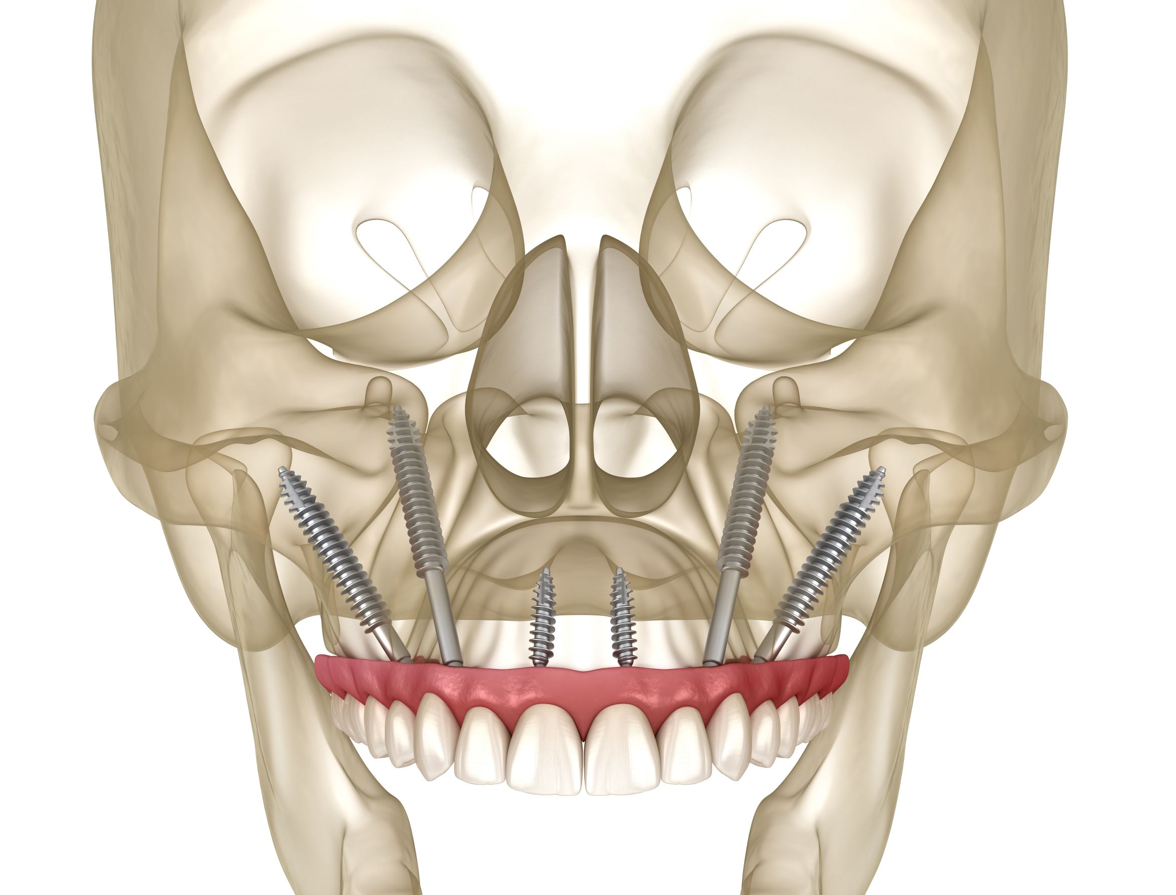 Zygomatic Implants