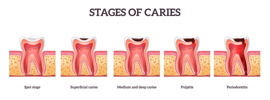 Stages of Caries