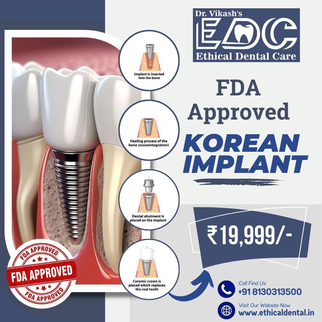 Dental Implants – Types, Process, and Expert Care by Dr. Vikash Kumar in Noida