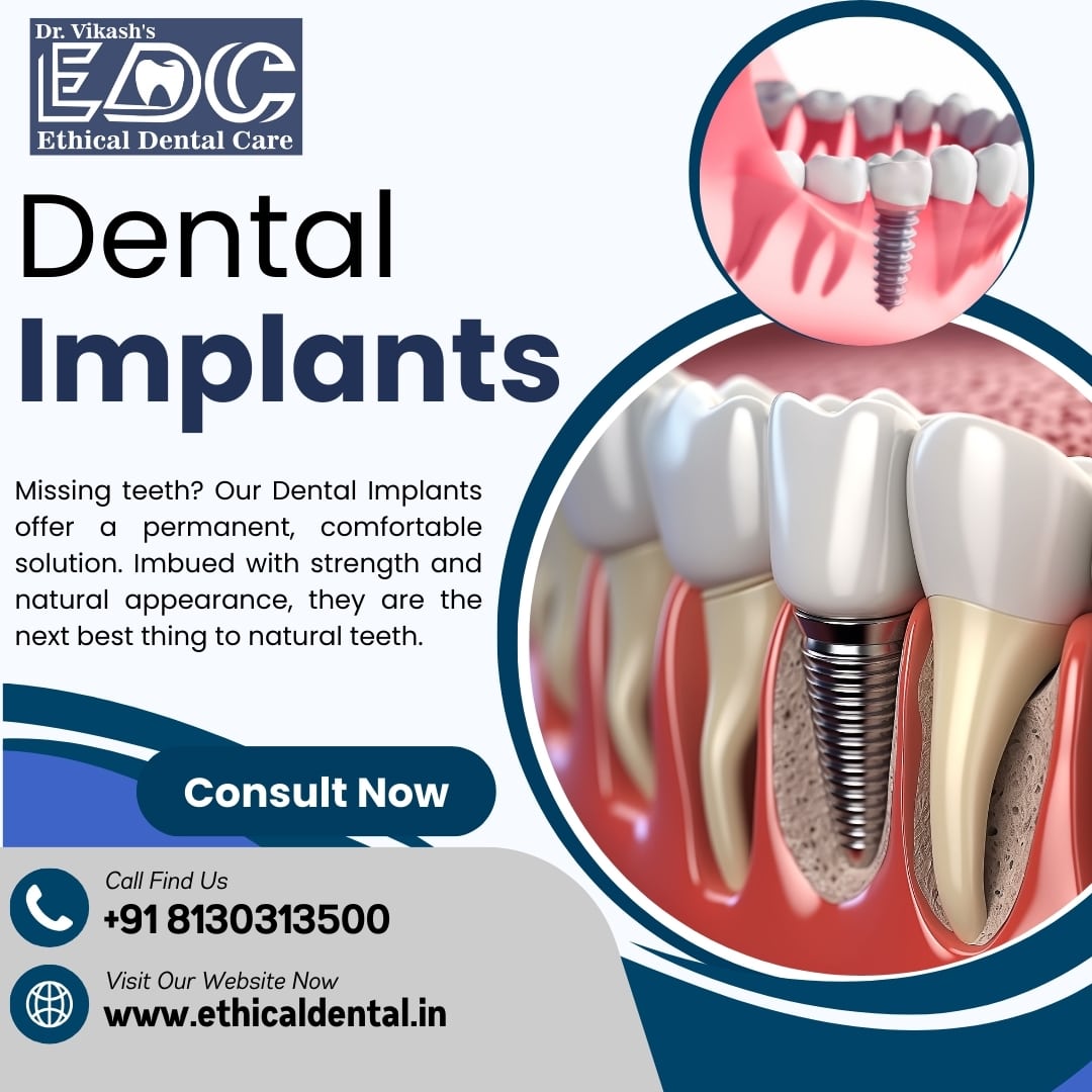 Best Dental Implant Treatment at Dr. Vikash’s Ethical Dental Care, Noida