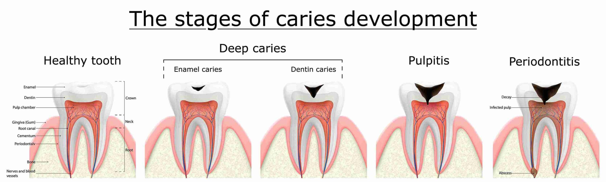 RCT procedure