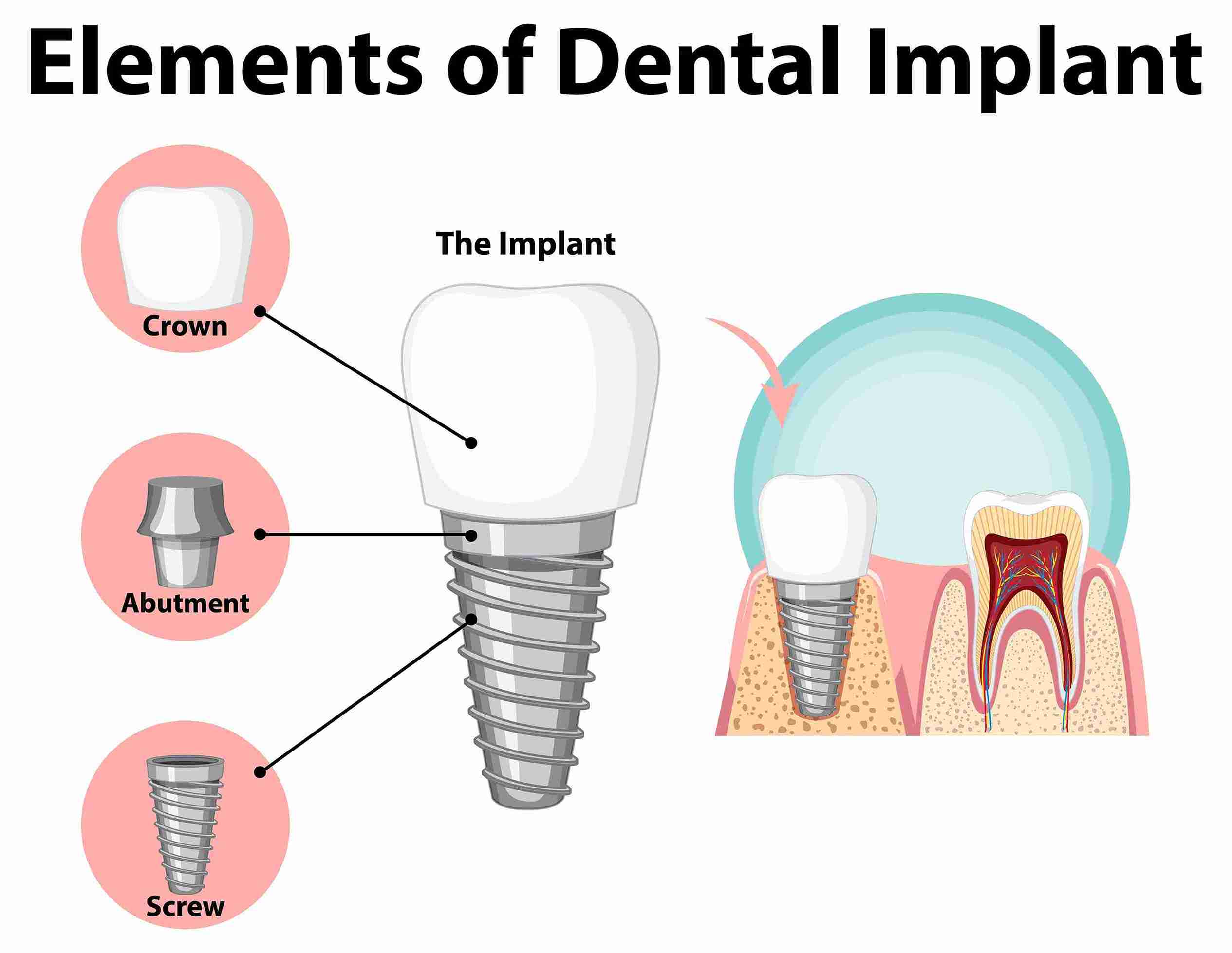 Dental Implants