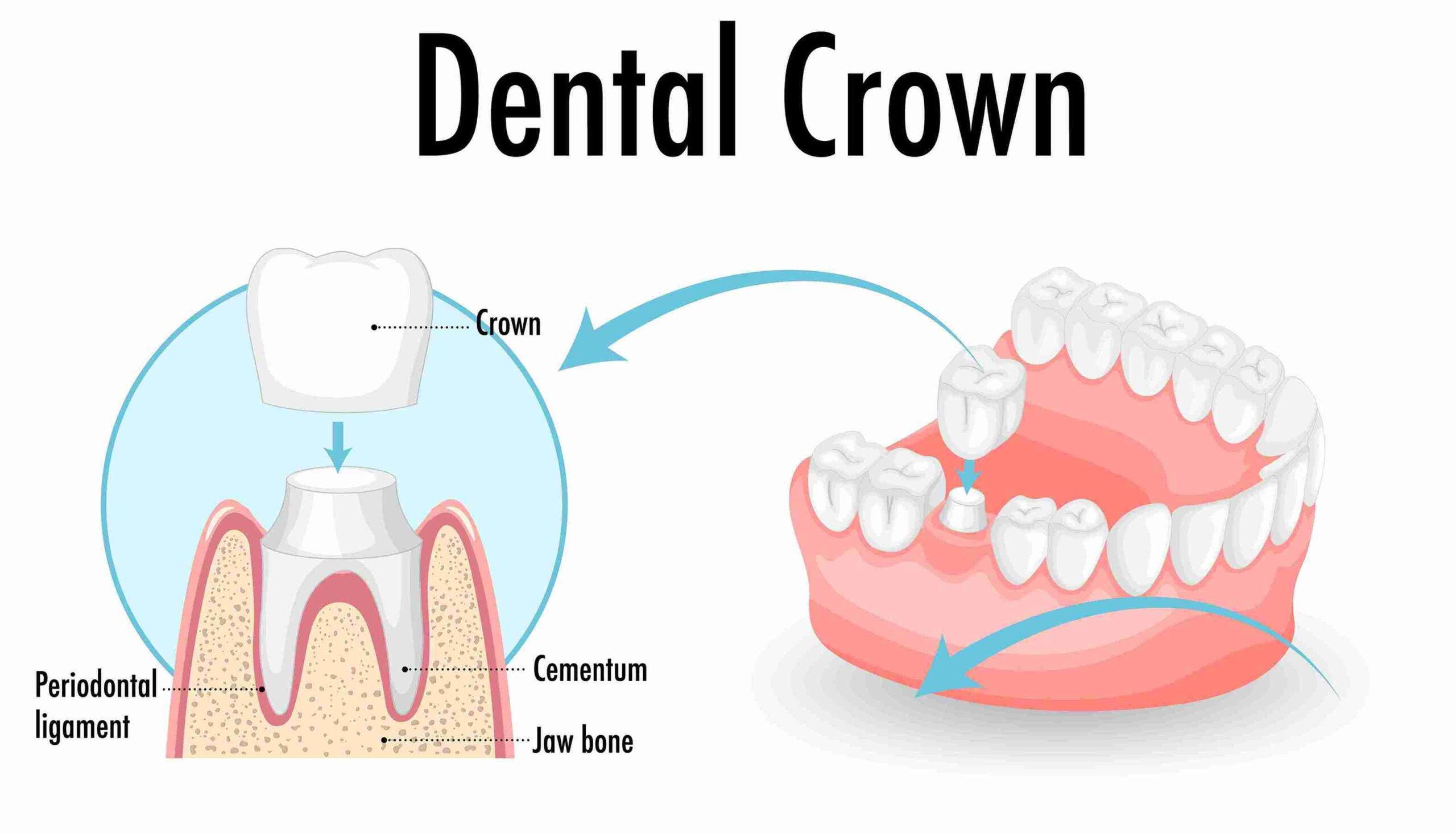 Dental Crowns