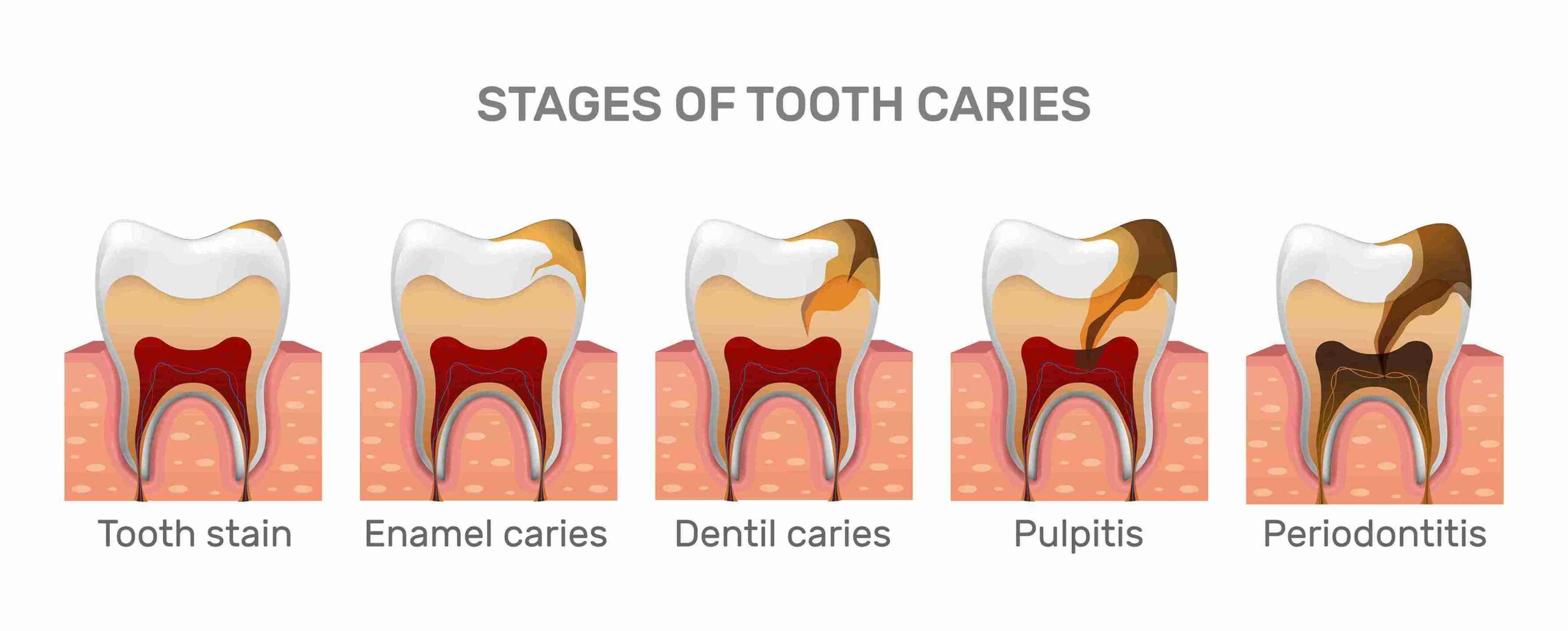 Root Canal Treatment