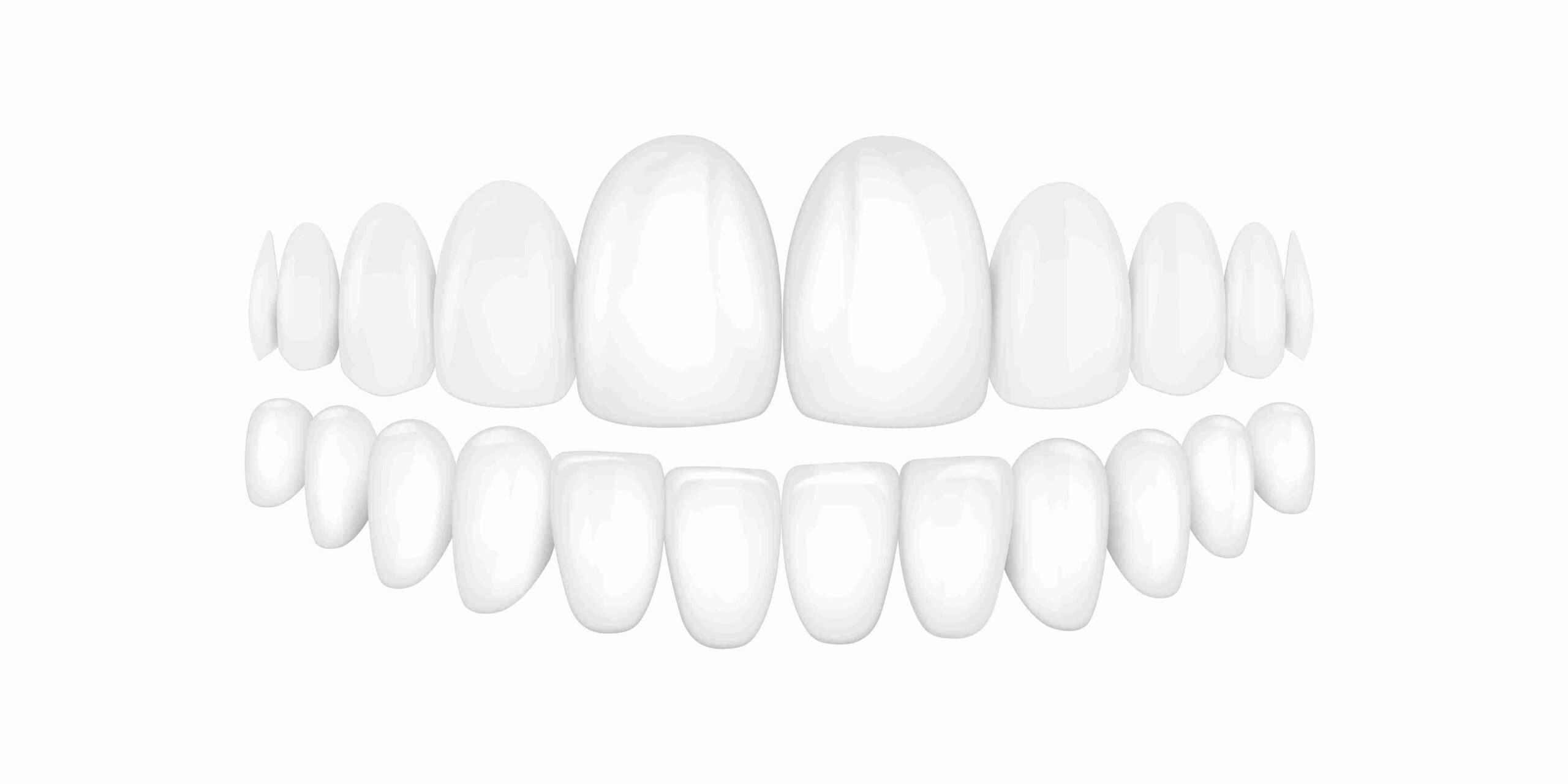 Dental Veneers