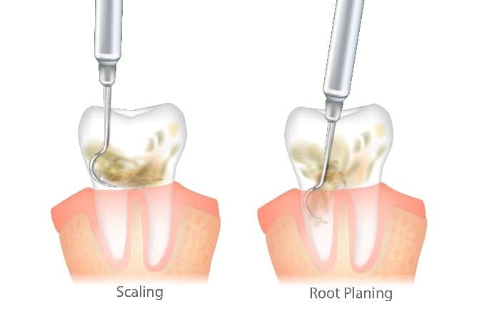 Scaling and Root Planing (Deep Cleaning)