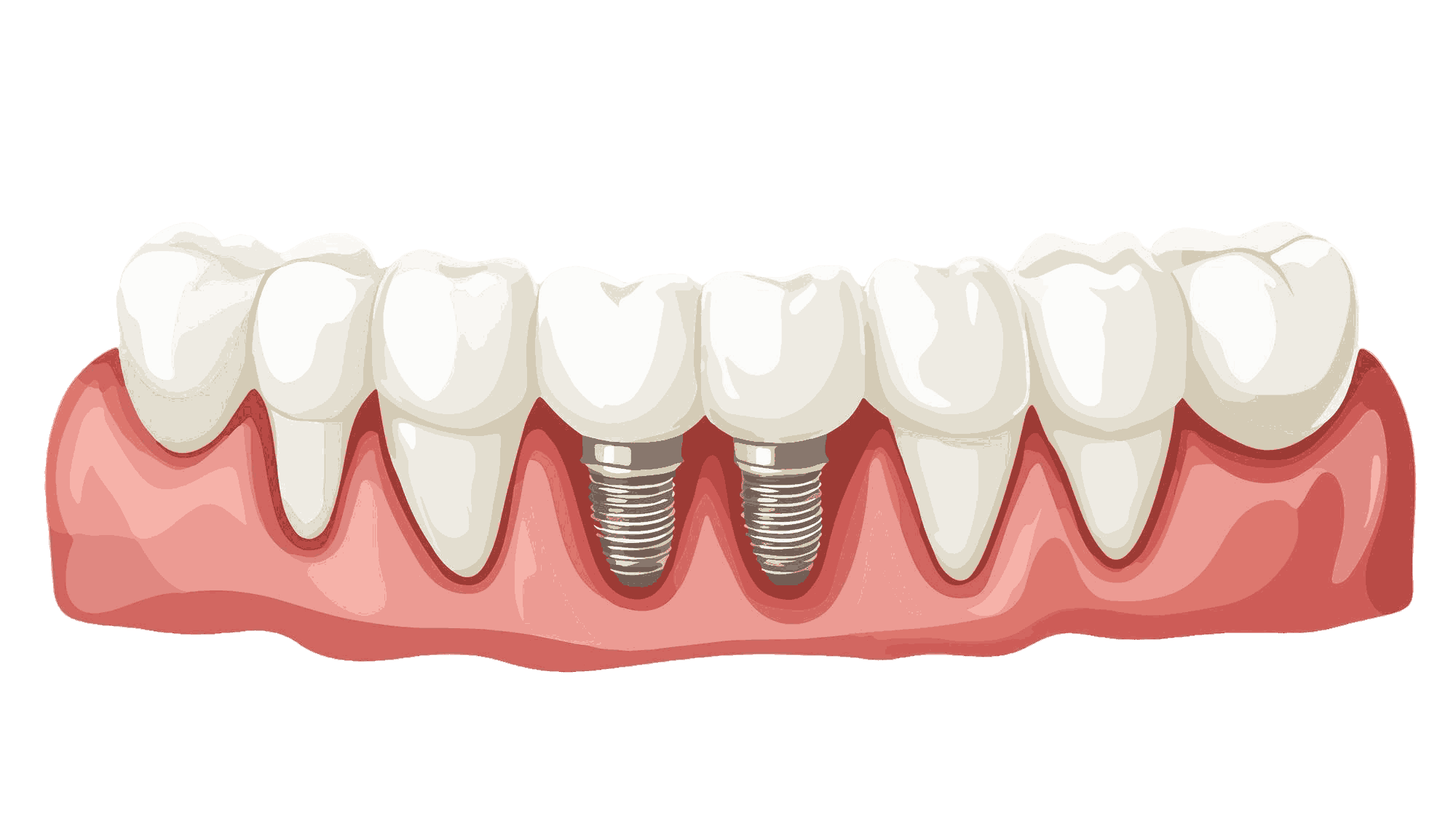 dental-implant