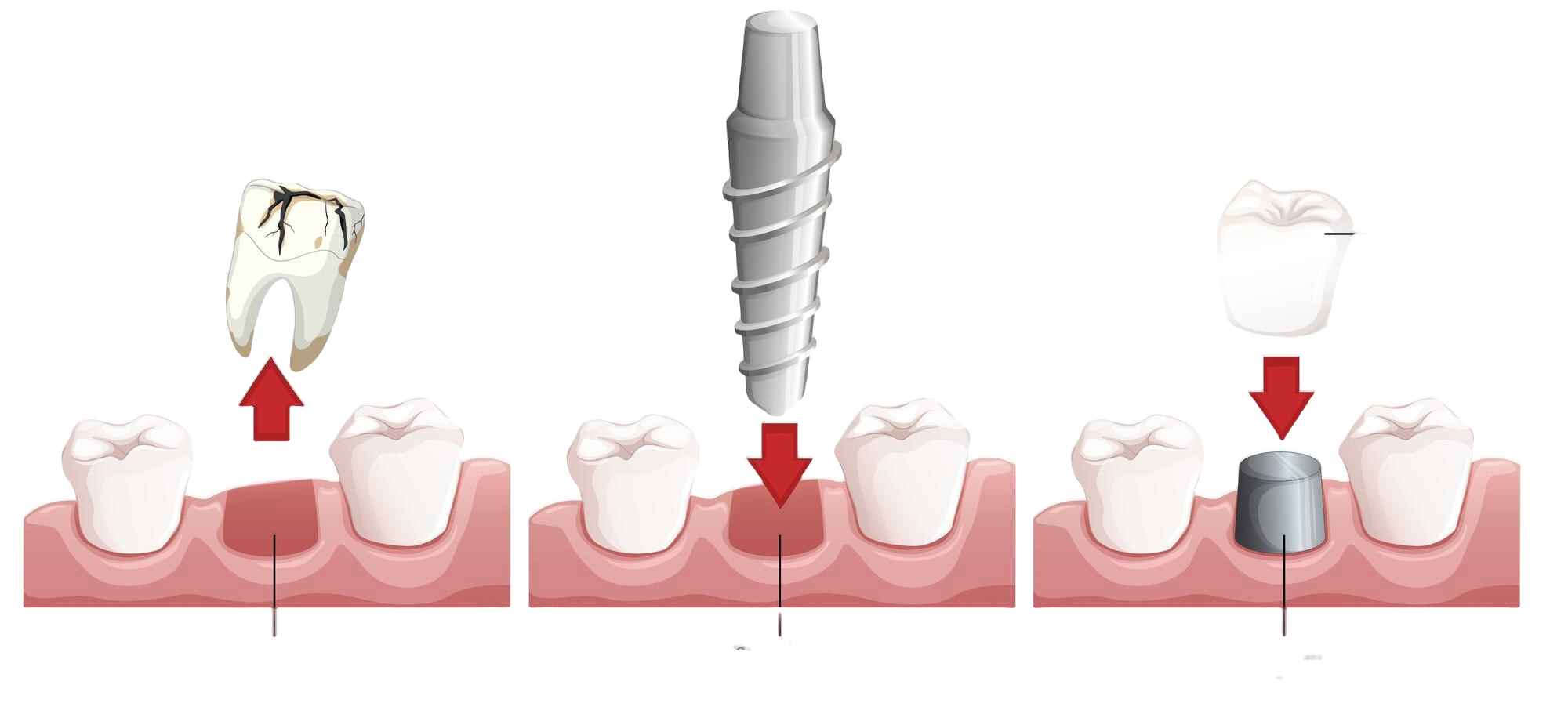 dental implant Process