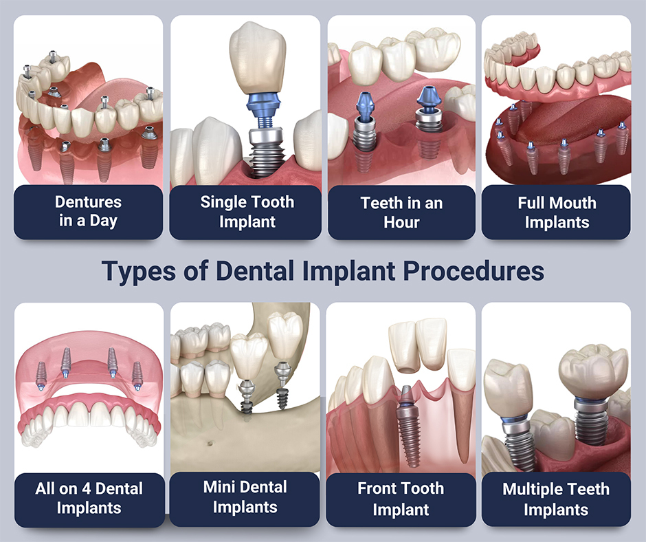 types-of-dental-implants-procedures